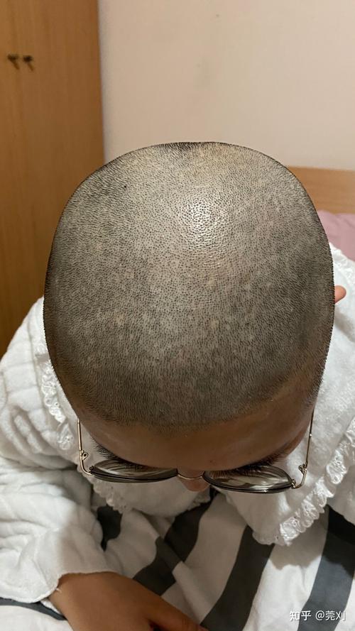 新澳800图库最新版本和因发量太多剃掉头发与因发量太多剃掉头发会怎么样